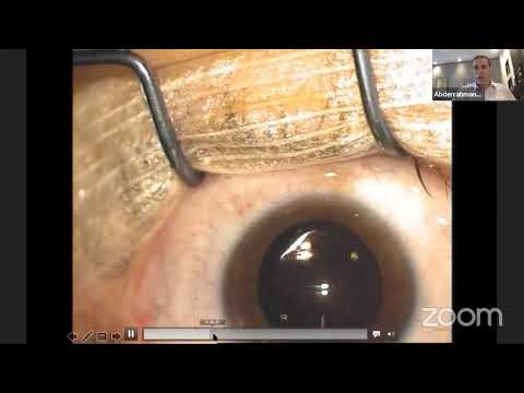 Vidéo: Résultats De Réfraction Chez Les Patients Atteints De Glaucome Subissant Une Extraction De Cataracte De Phacoémulsification Avec Et Sans Goniotomie à Double Lame De Kahook