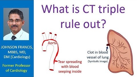What is CT triple rule out?