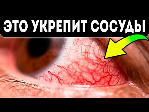 Вот почему сосуды глаз лопаются! 15 домашних способов, которые избавят вас от красных глаз