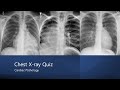 Chest xray quiz cardiac pathology