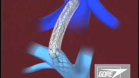 Endoprótese TIPS GORE® VIATORR®