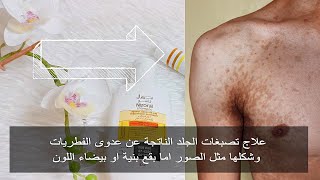 افضل علاج فعال للفطريات الجلدية