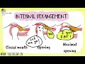INTERNAL DERANGEMENT| ANTERIOR DISK DISPLACEMENT - LEARN THE EASIEST WAY POSSIBLE!