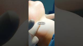 Neck Liposuction Surgery Results