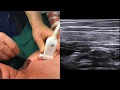 Ultrasound-guided infraclavicular brachial plexus block