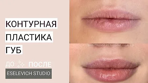 Контурная пластика губ. Какой объем гиалуроновой кислоты лучше колоть в губы? Препарат Juvederm