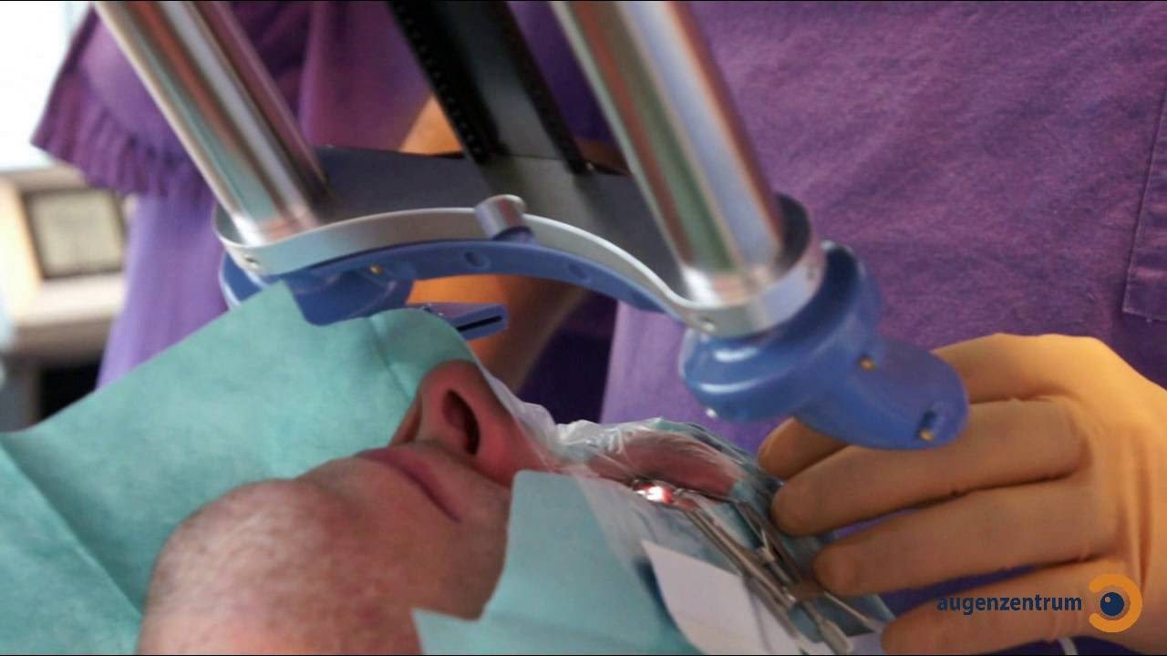 Augenlasern mit der PRK/LASEK Methode - Lasik Care