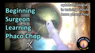 beginning surgeon learns phaco chop for the first time (Cataract Surgery)