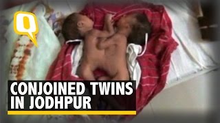 Woman Gives Birth to Conjoined Twins in Jodhpur, Seek Medical Help