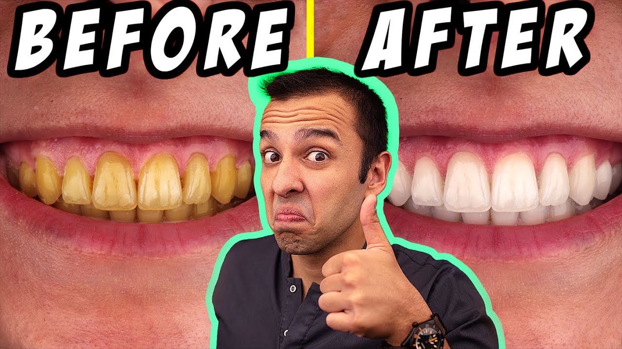 ОТБЕЛИВАНИЕ ЗУБОВ ДОМА | 