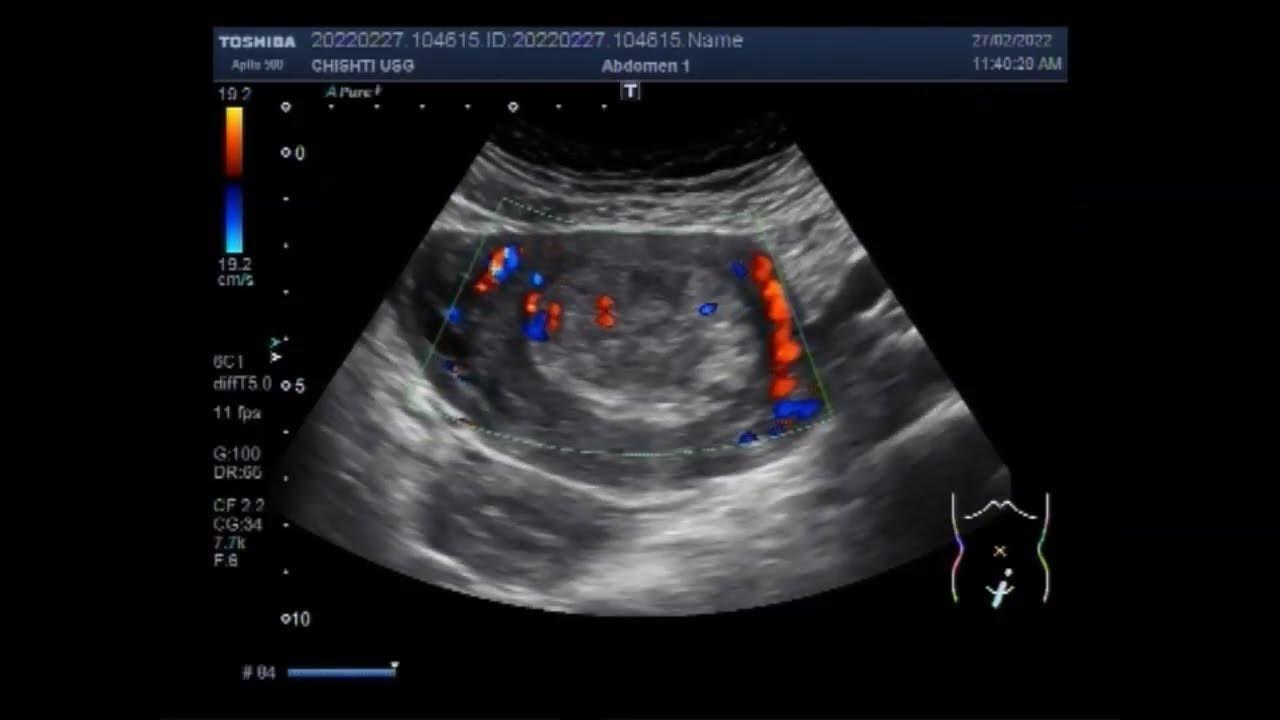 Cervical Polyp And Pelvic Pain