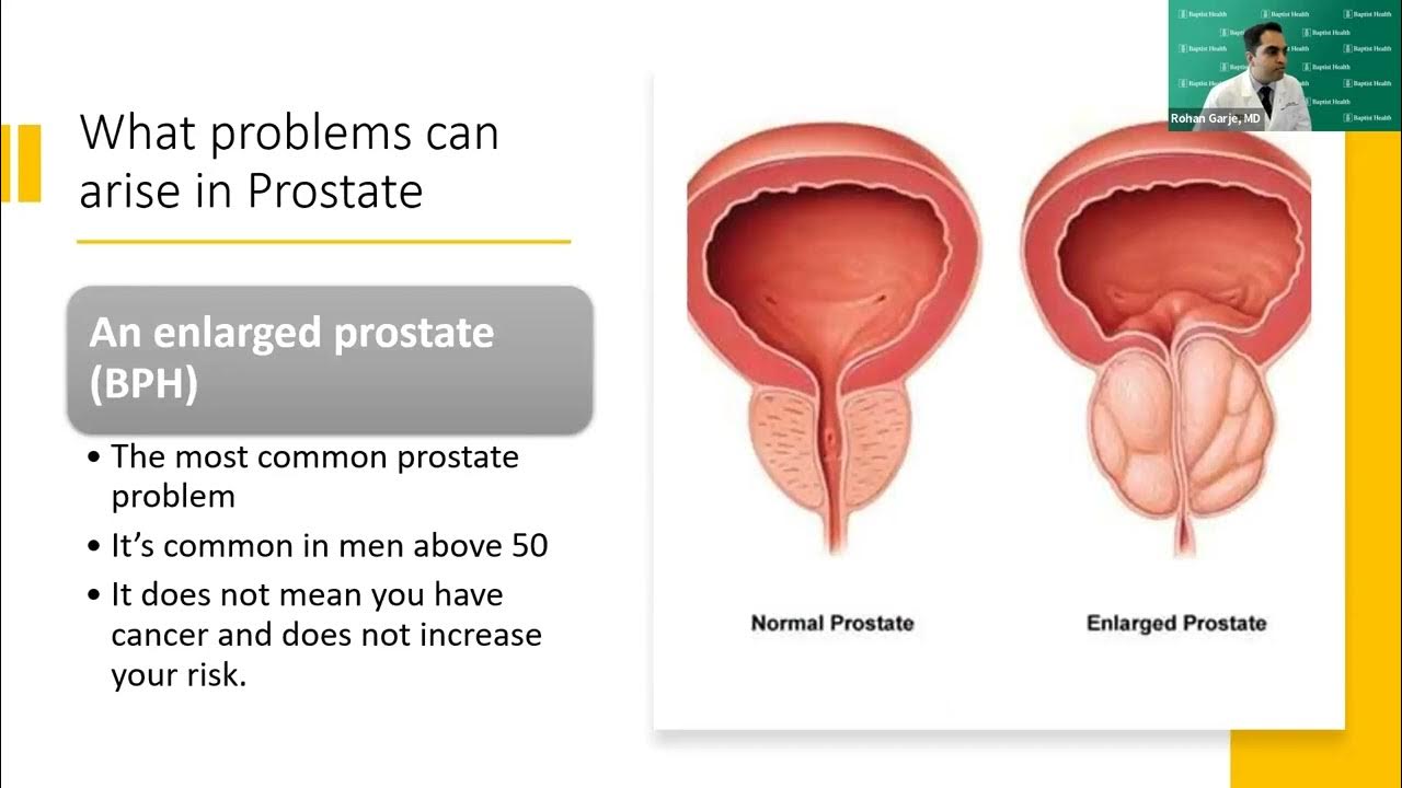 Reducing the risk and early detection of genitourinary cancers in men