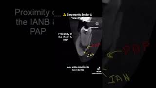 ⚠️Bioceramic Sealer & Parasthesia #drricoshort #endodontics #dental #dentalprocedure