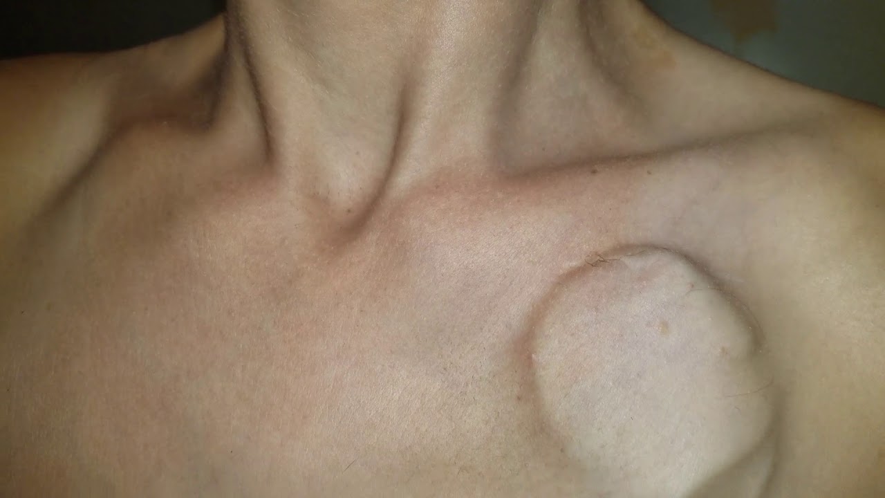 Pacemaker sticking out of chest