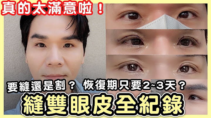 #术前术后必看 我终于去缝双眼皮啦！真的太满意了 ll Kevin想得美 ll - 天天要闻