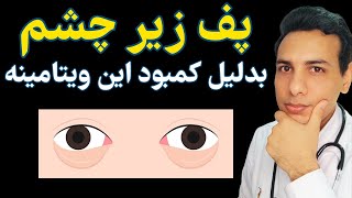 علل پف زیر چشم و راهکارهای برطرف کردن آن | Puffiness under the eyes