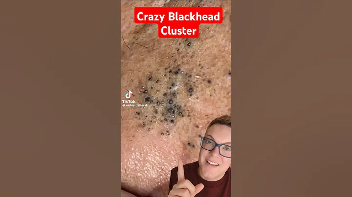 Extreme 30 Year Old BLACKHEAD REMOVAL #shorts