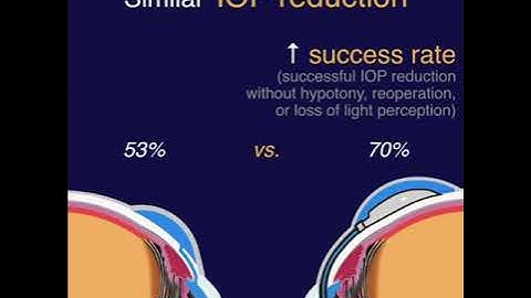 TVT - Tube vs Trab Study