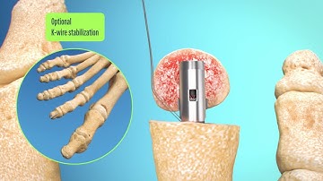 Toetal Solutions Ziptoe™