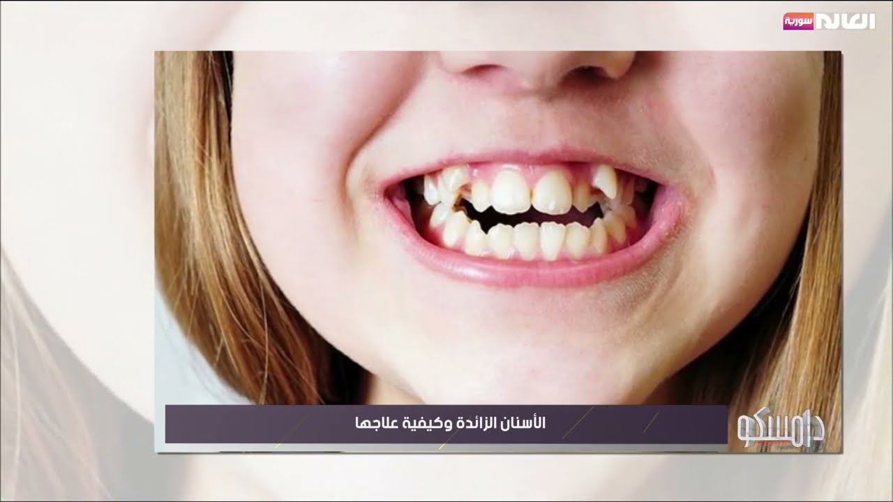 الأسنان الزائدة وكيفية علاجها| برنامج دامكسو