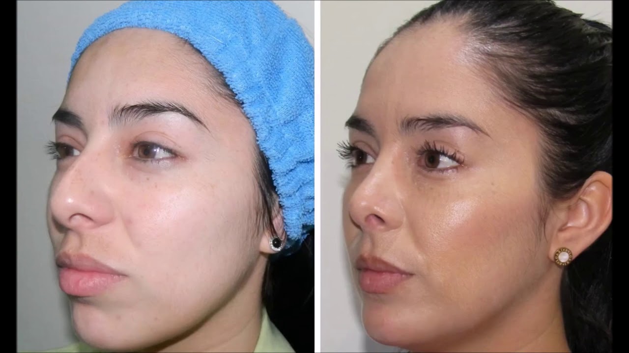 Antes y Después de Rinoplastia y Mentoplastia, Dr. Rogelio Reza - YouTube