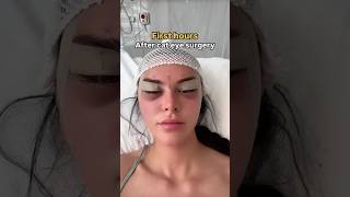 Download Lagu Cat Eye Surgery ✨ | Stunning Before \u0026 After Transformation MP3