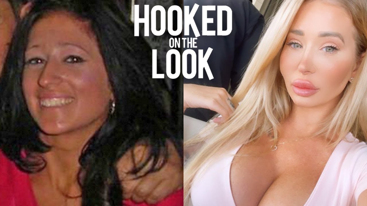 I've Spent 0K On My Plastic Surgery Transformation | HOOKED ON THE LOOK