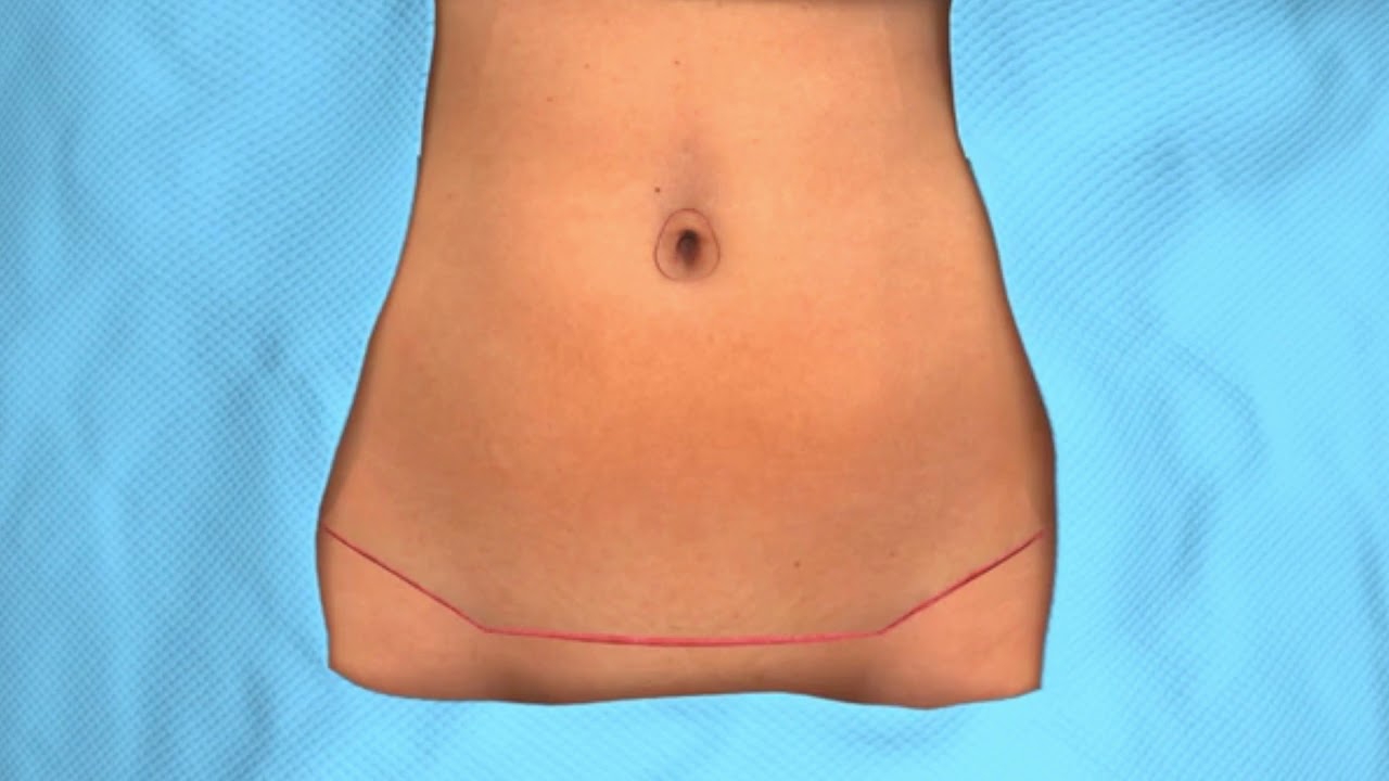 The Scope Blog - Which Type of Tummy Tuck Is Right for Me