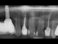 Immediate dental implant placement dentiumworld dranwaralabdullah