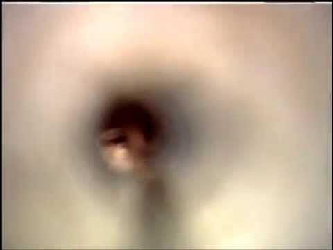 Miringotomia más colocación de tubos de ventilación YouTube