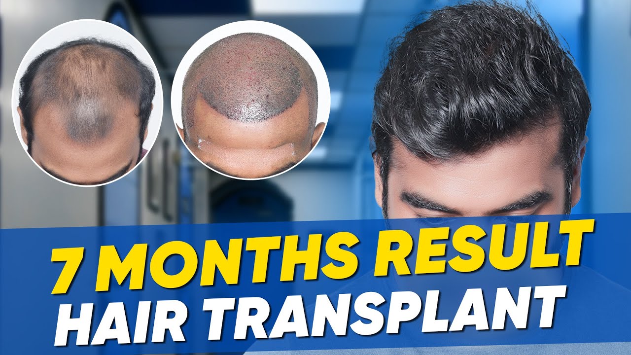 Hair Transplant in Madurai Best Results & Cost of Hair Transplant in