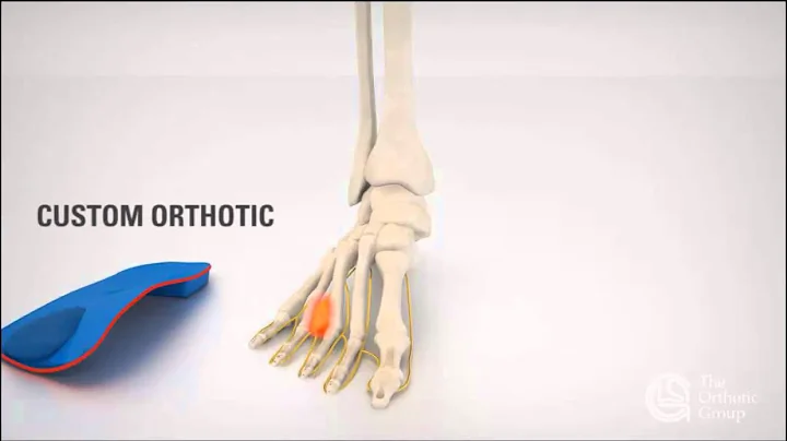 Biomechanix Clinic Ltd - Morton's Neuroma