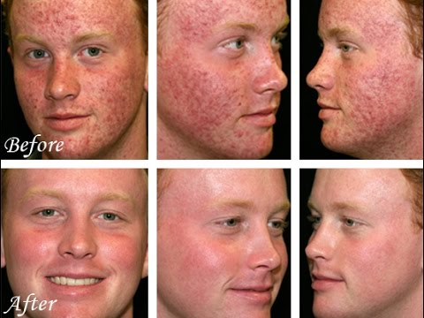How a Raw Food Diet Cured my Acne