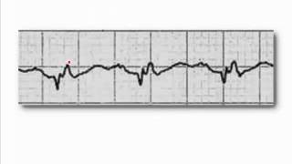 ECG: Exercise # 27