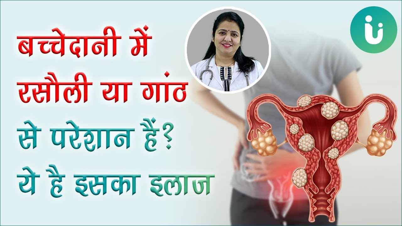 बच्चेदानी में गांठ या रसौली होने का कारण, लक्षण, इलाज, उपचार, दवा - Fibroid ka ilaj in hindi