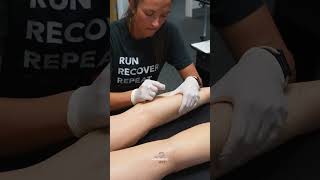 Dry Needling Tight Calves After Running