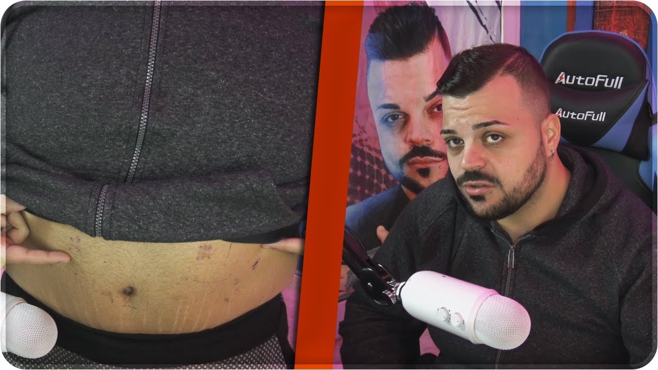 dieta dopo una manica gastrica