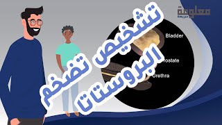 أعراض تضخم البروستاتا