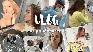 Ринопластика. VLOG//моя история. Как выбирала врача? Цена? ДО и ПОСЛЕ