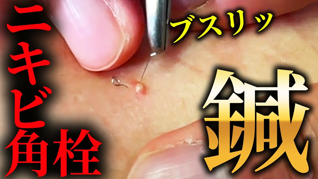 角 栓 背中