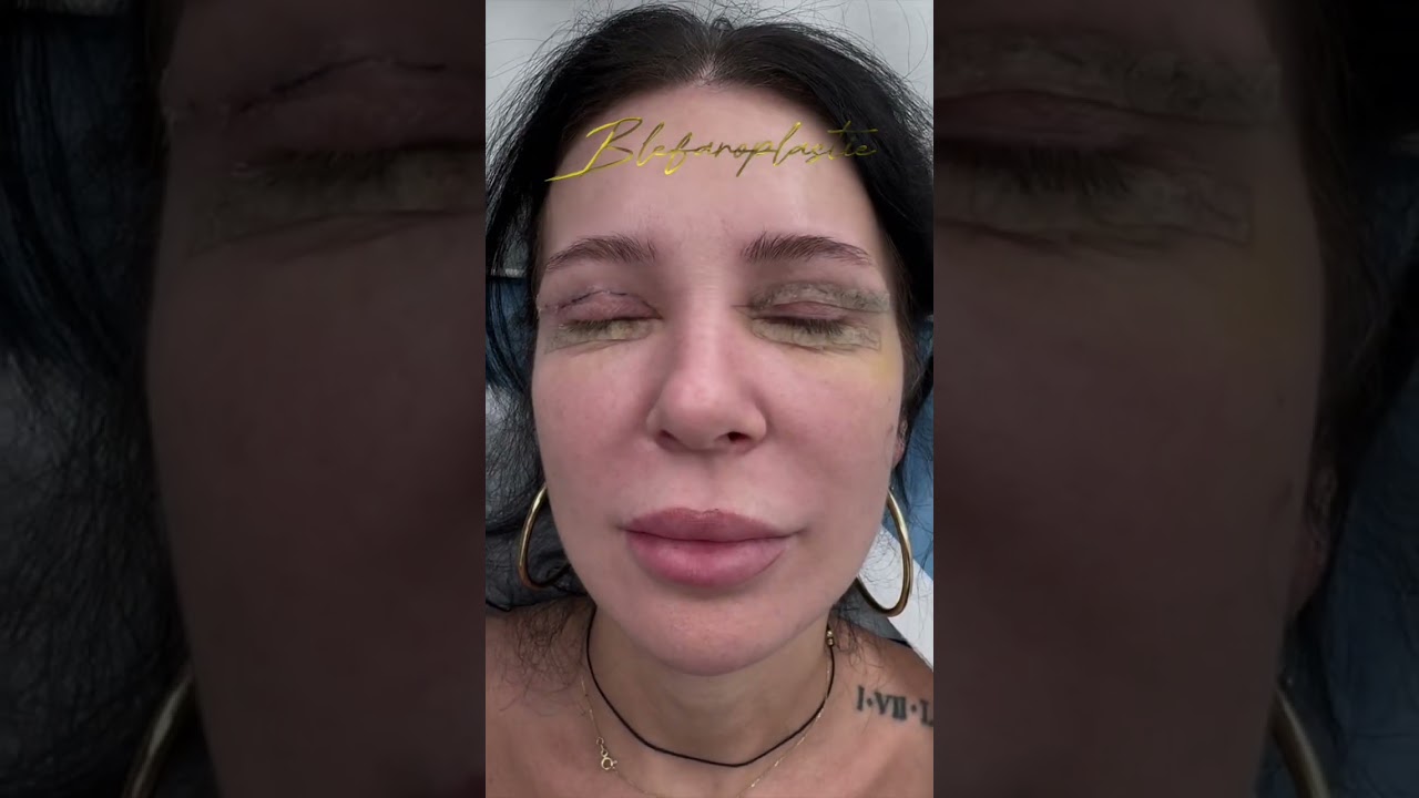 Rezultat operație Blefaroplastie superioară și inferioară (la Clinica Doctor Levy din București)