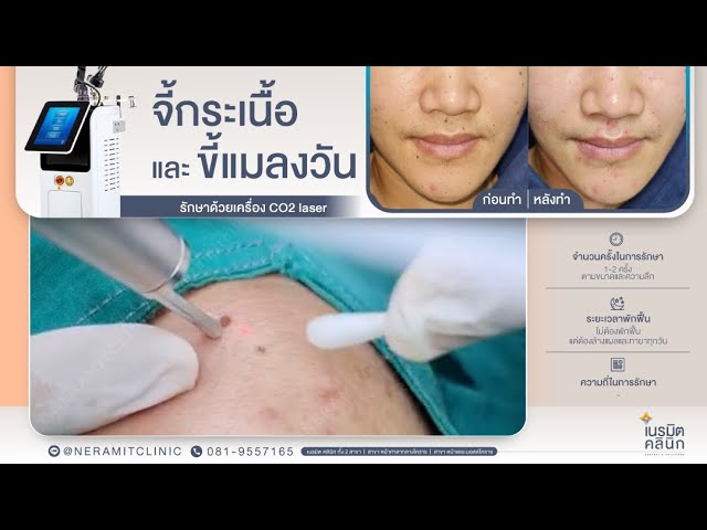 รีวิวตัดไฝ ขี้แมลงวัน EP.191/กระเนื้อ ขี้แมลงวันเสริมโหงวเฮ้ง @หมอปุ๊ Neramit Clinic