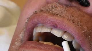 Hemangioma Laser Treatment
Watch as Dr. Sanda Moldovan performs a Hemangioma Laser Treatment on her patients lip. Click the link below for more information!
http://www.beverlyhillsdentalhealth.com/laser-therapy/
http://www.drsandamoldovan.com
http://www.twitter.com/drsanda
http://www.facebook.com/askdrsanda
ABOUT
Dr. Sanda Moldovan is an award-winning periodontist and nutritionist as seen on CBS renowned TV show The Doctors. With a firm belief in health from the inside out, Dr. Moldovan identifies health issues that originate in the mouth to empower patients towards a healthier life. She is a Diplomate of the American Academy of Periodontology and a member of Laser Dentistry and American College of Nutrition. Smile to a healthy future and stay connected with Dr. Moldovan! Hemangioma Laser Treatment