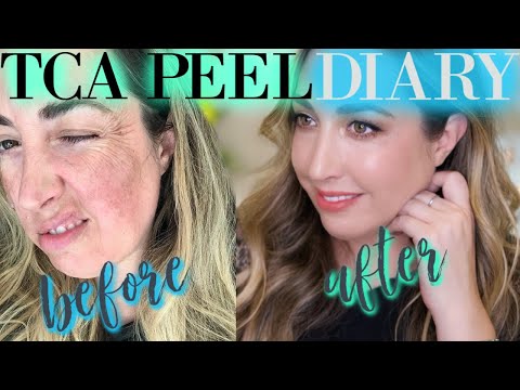 TCA Peel Diary | Before and After | Chemical Peel at HOME