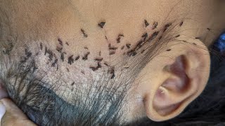 Pick out all big lice from head - Remove a lot of lice from short hair