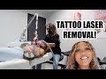 GETTING MY TATTOOS LASER REMOVED!!!!!!!!!