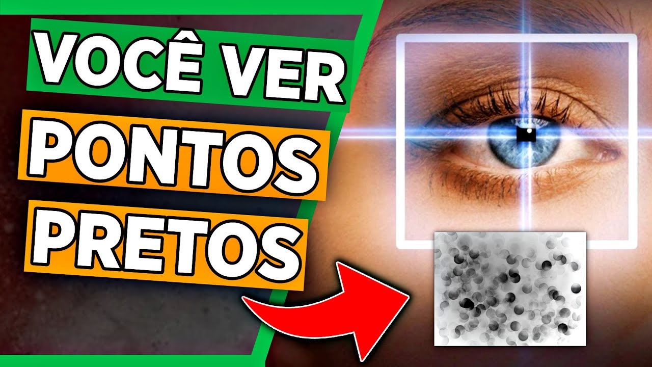 Pontos Preto na Visão: Como Tratar Pontos que Flutuam Diante dos Olhos ...