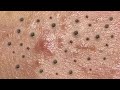 Satisfying Hien Spa Beauty Relaxing Video #20