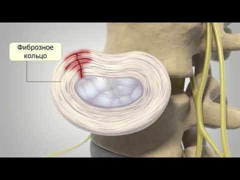 Грыжа межпозвонкового диска: причины, симптомы