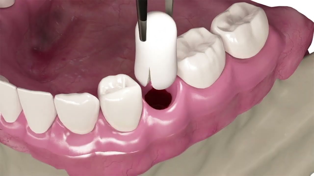 DSI-Sponge Gelatine Foam: Managing Bleeding and Post-extraction Socket